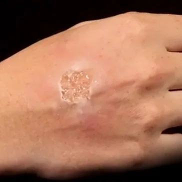 Grimas Blister Gel smink, hólyagok szimulálására