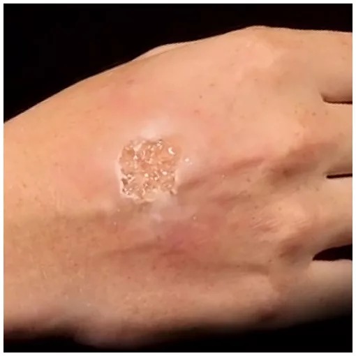 Grimas Blister Gel smink, hólyagok szimulálására